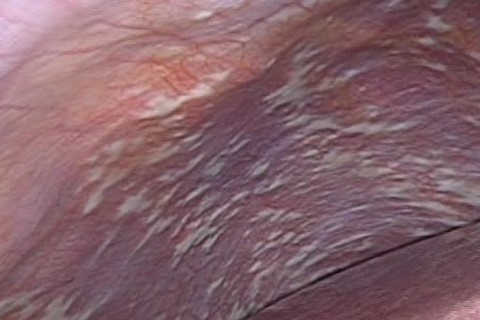 腹膜播種
